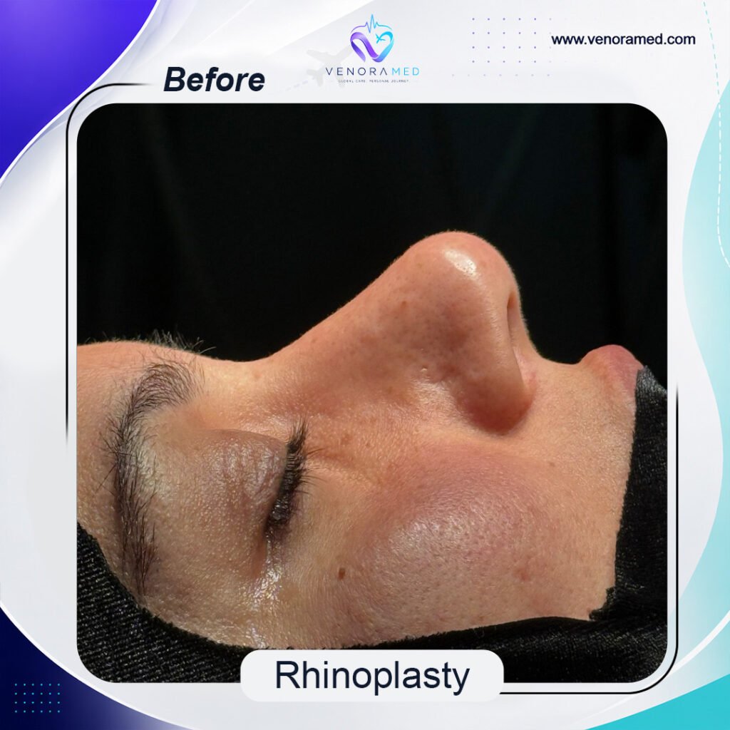 Rhinoplusty before