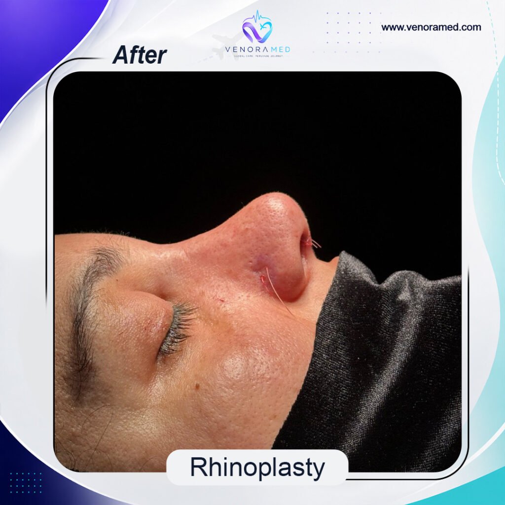 Rhinoplusty after