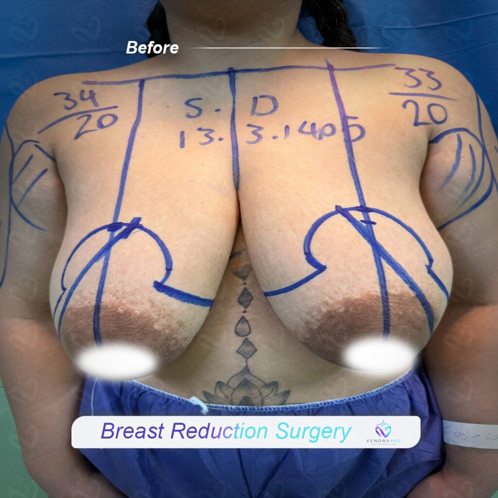 Breast Reduction surgery  before