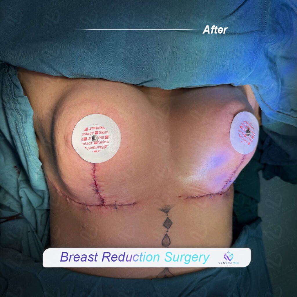 Breast Reduction surgery  after