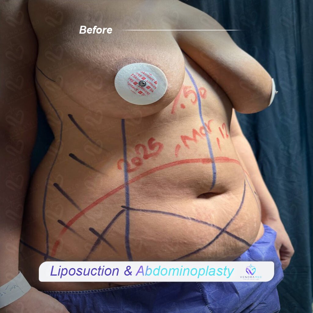 Liposuction & Abdominoplasty before