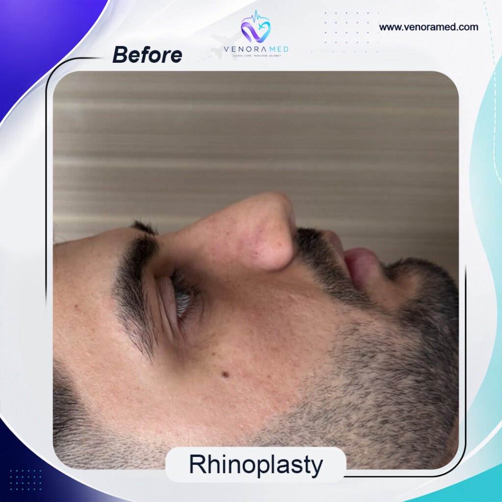 Rhinoplasty before
