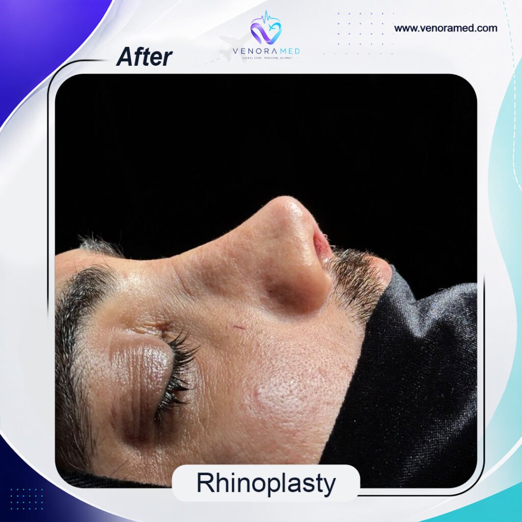 Rhinoplasty after