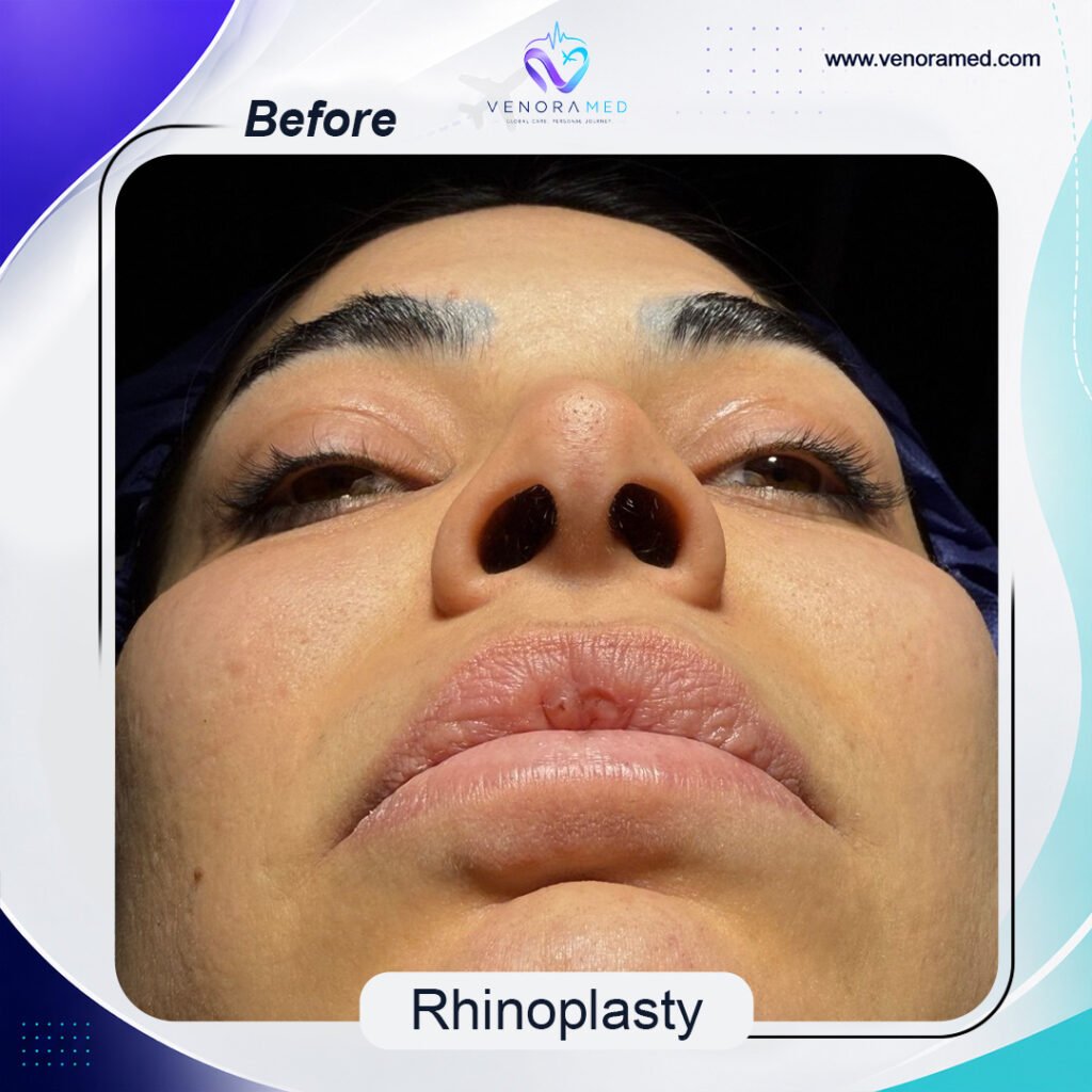 Rhinoplasty before