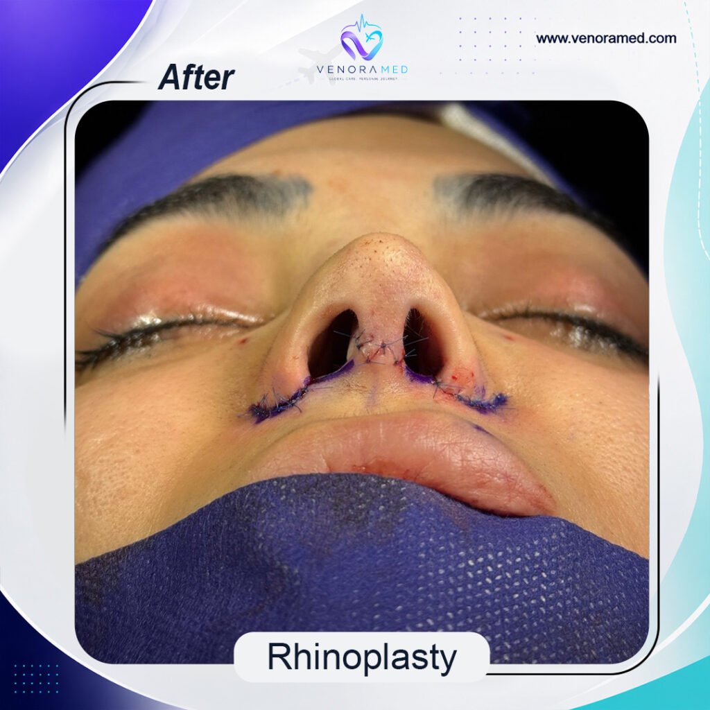 Rhinoplasty after