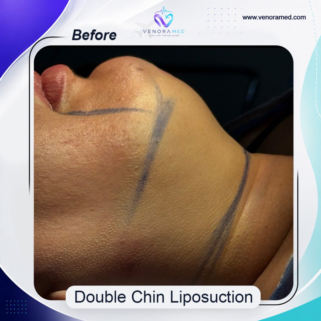 Double Chin Liposuction before