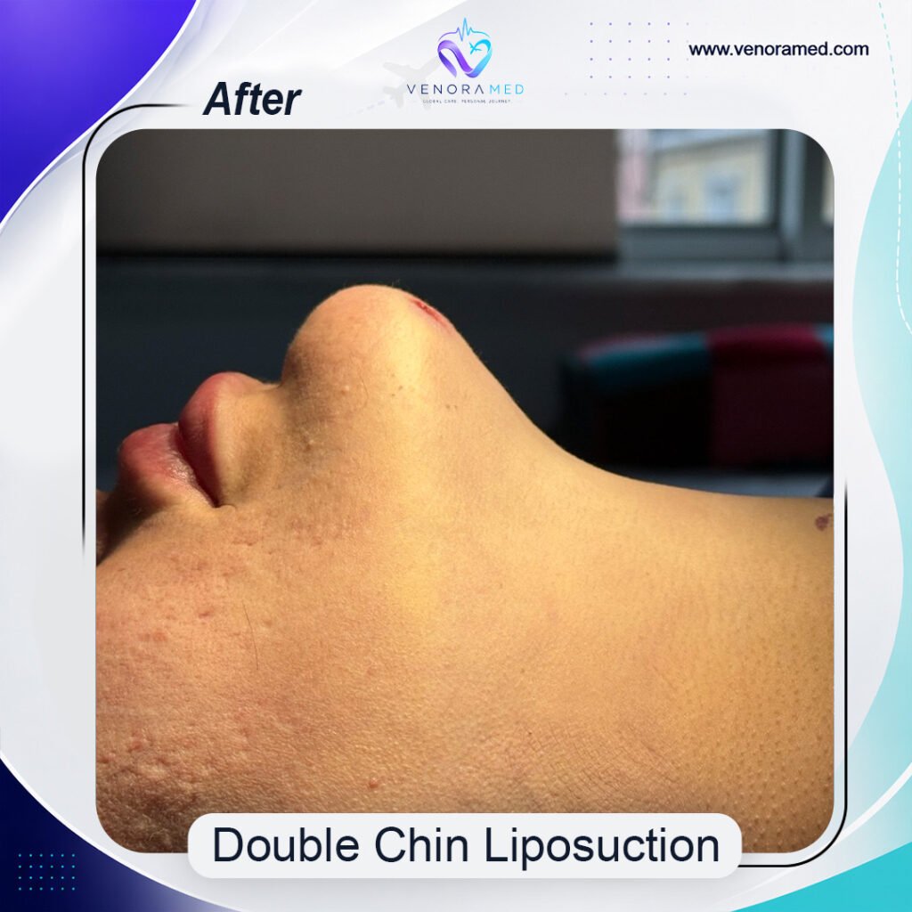 Double Chin Liposuction after