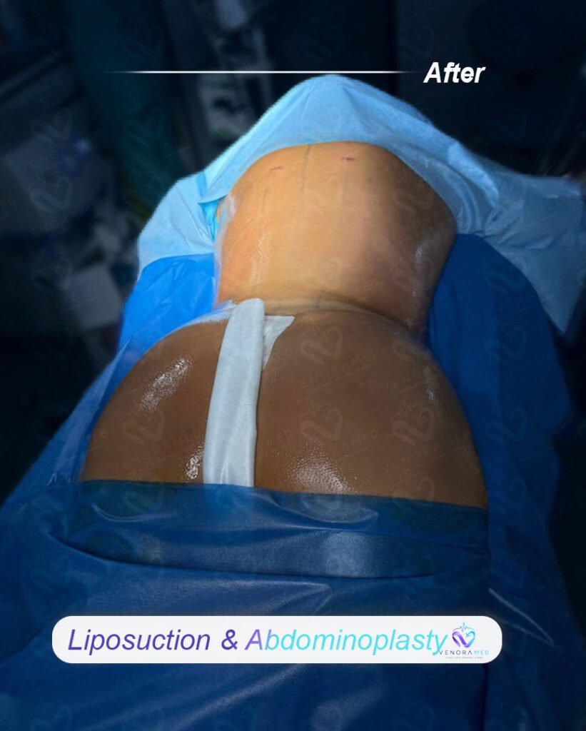 Liposuction & abdominoplasty after