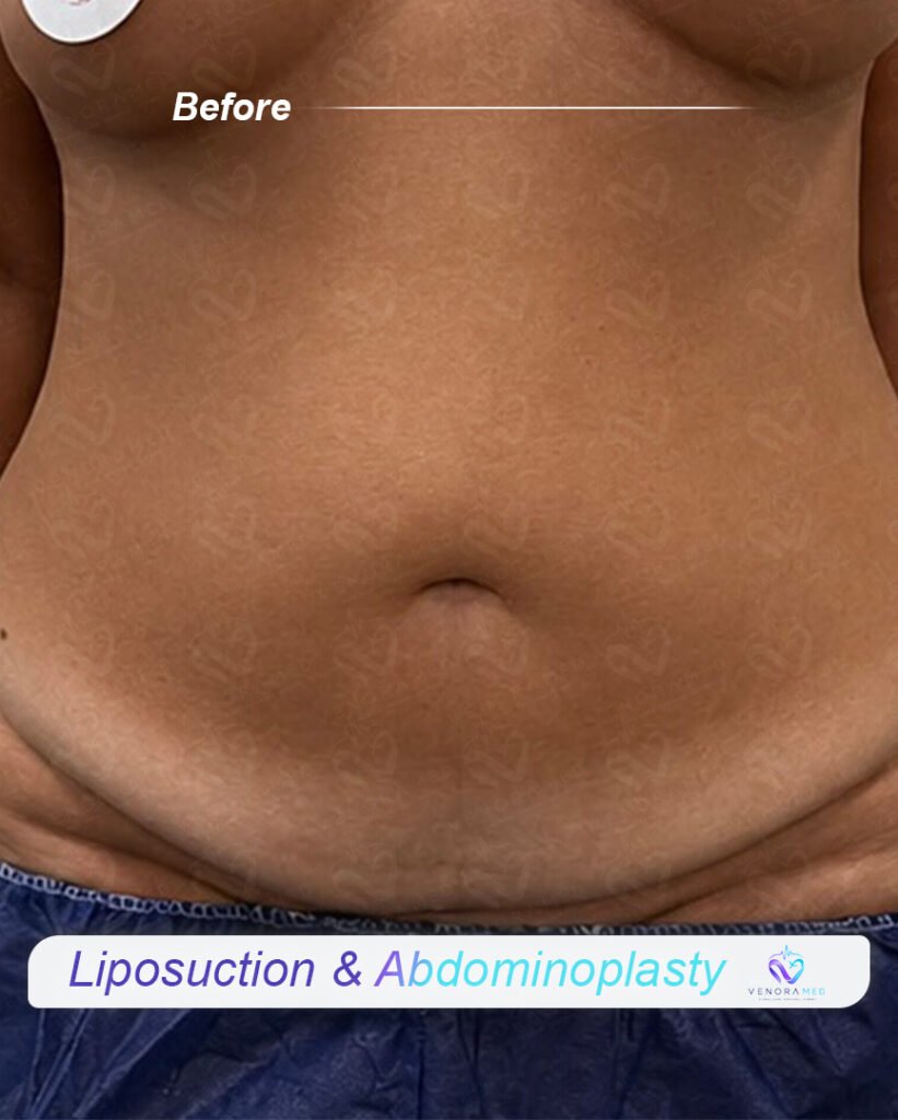 Liposuction & abdominoplasty before