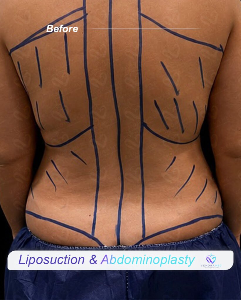 Liposuction & abdominoplasty before