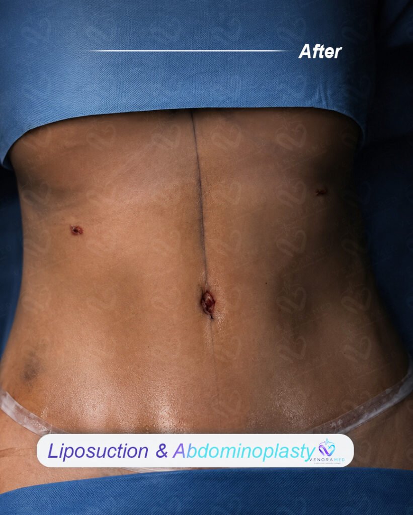 Liposuction & abdominoplasty after