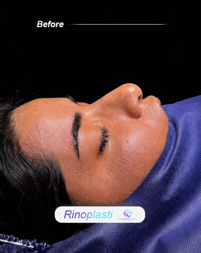 Rhinoplasty before