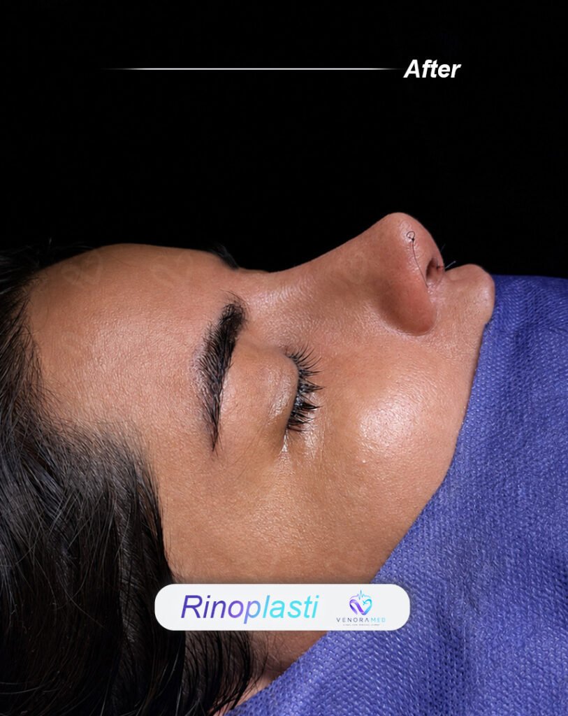 Rhinoplasty after
