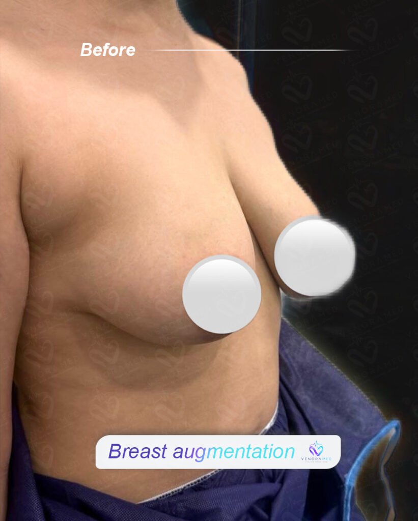 Breast Augmentation before