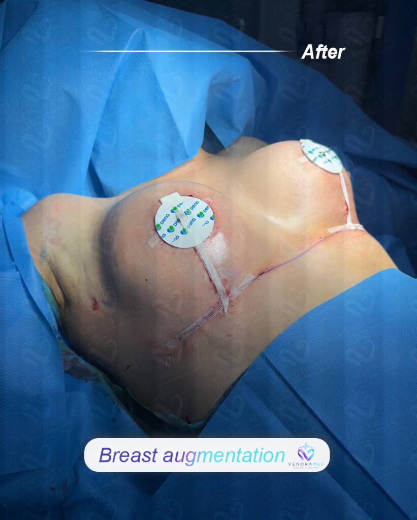 Breast Augmentation after