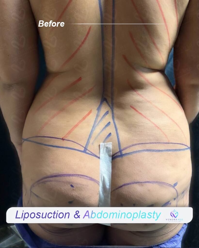 Liposuction & abdominoplasty before