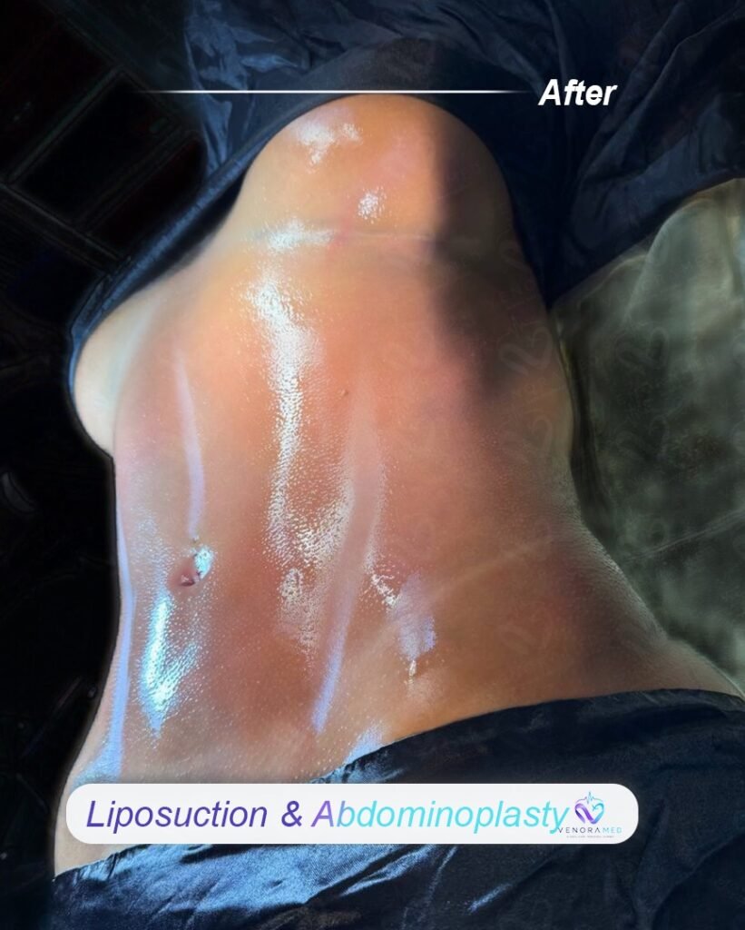 Liposuction & abdominoplasty after