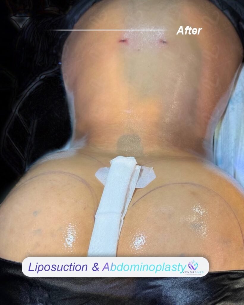 Liposuction & abdominoplasty after