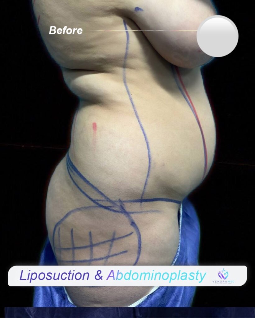 Liposuction & abdominoplasty before