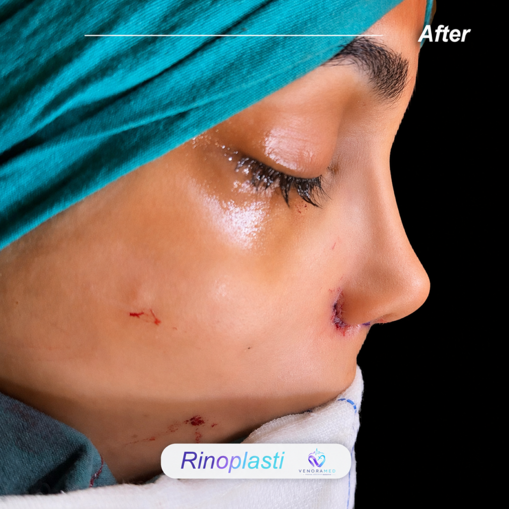 Rhinoplasty after