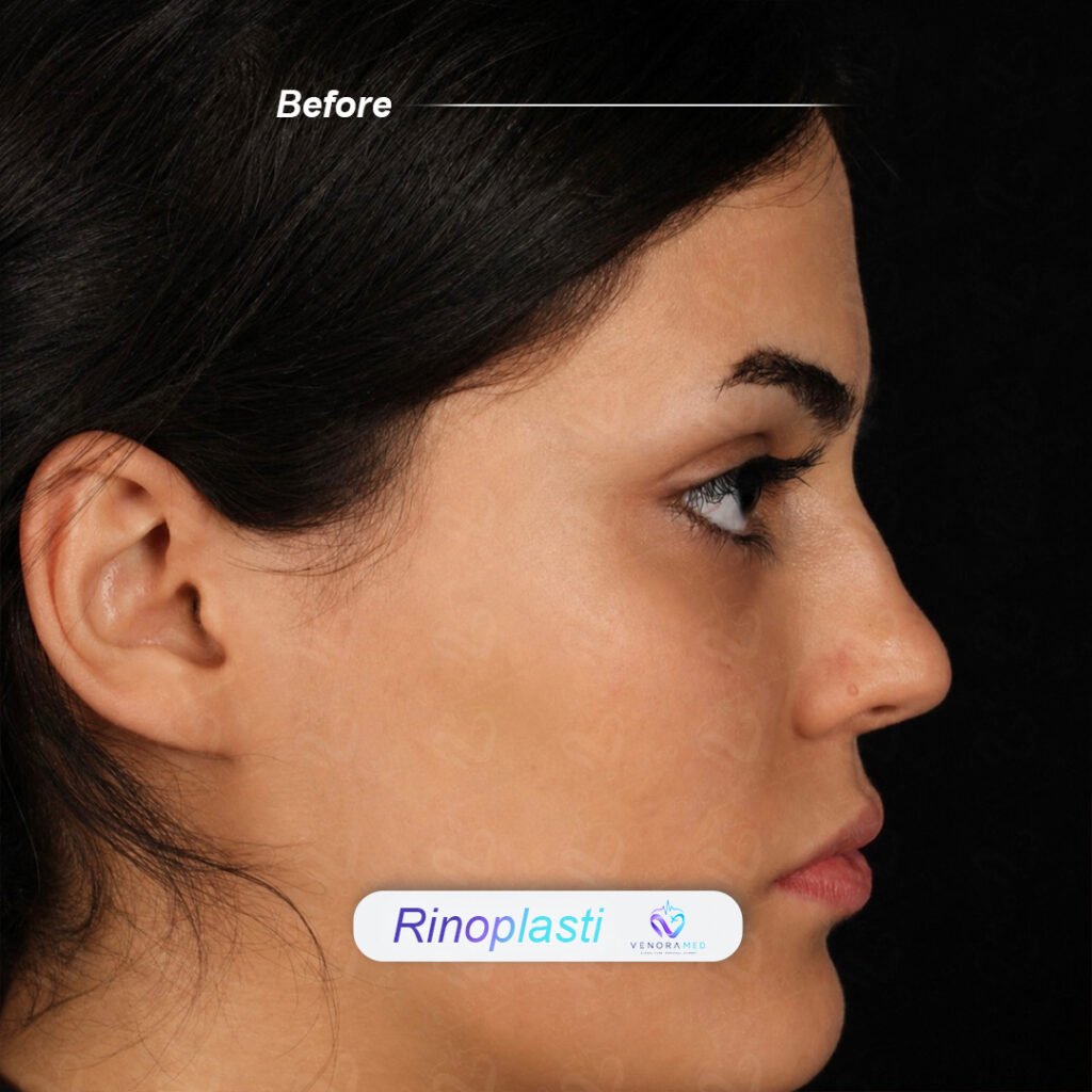 Rhinoplasty before