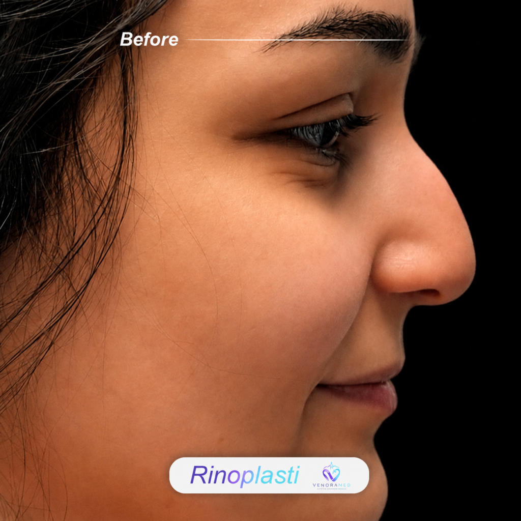 Rhinoplasty before