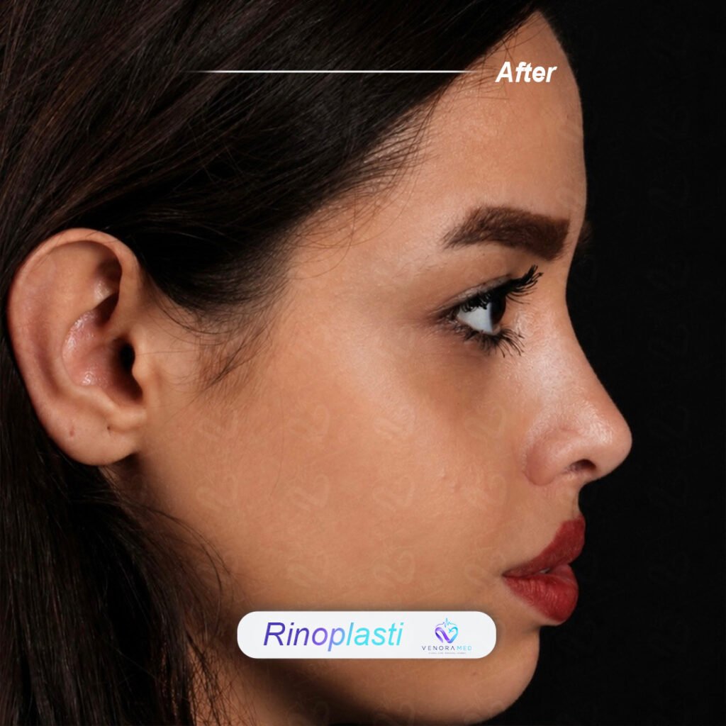 Rhinoplasty after