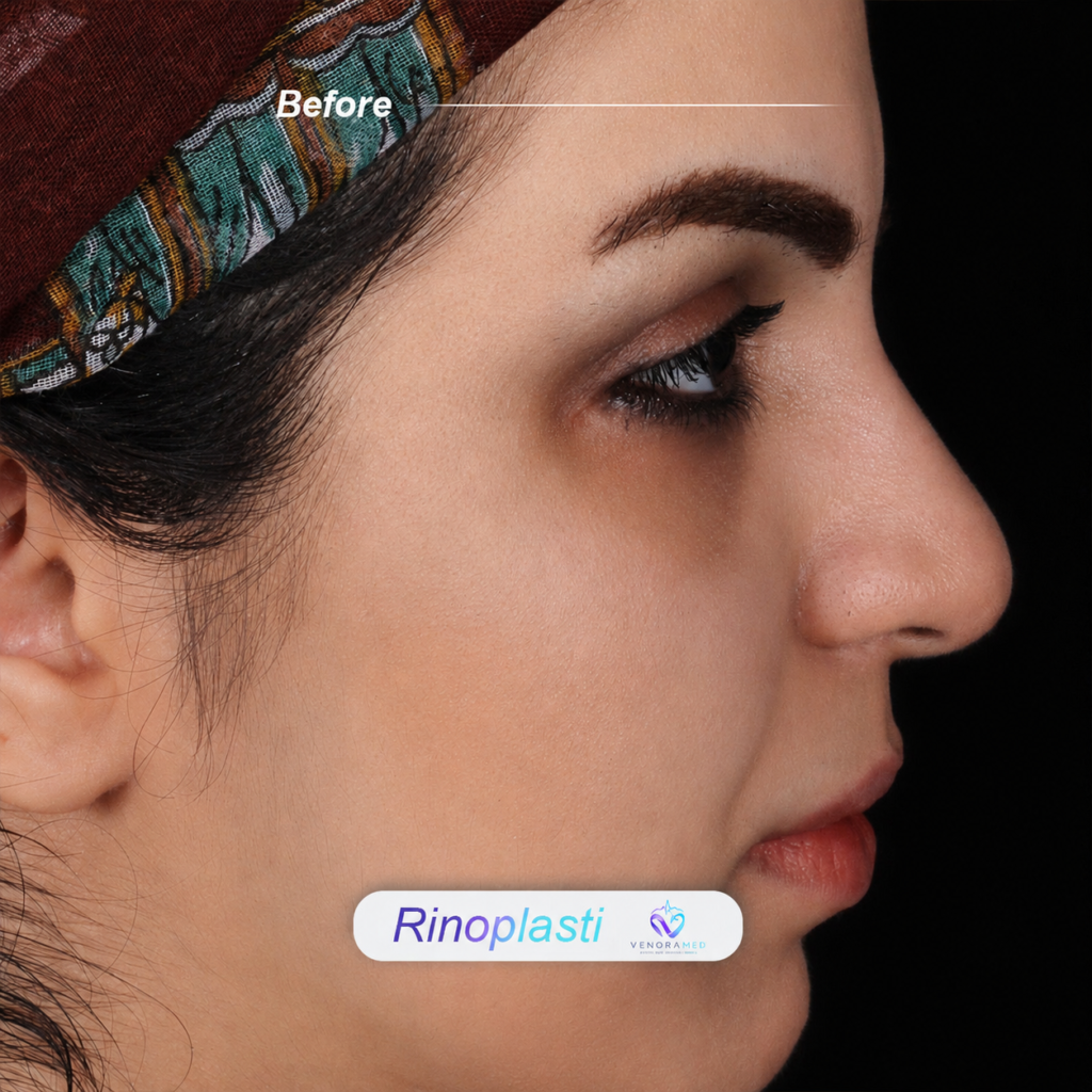 Rhinoplasty before