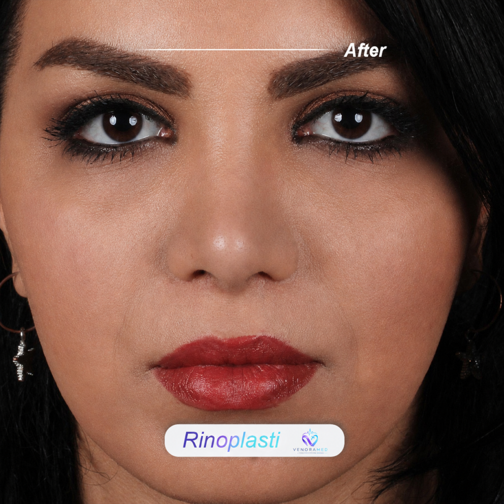Rhinoplasty after