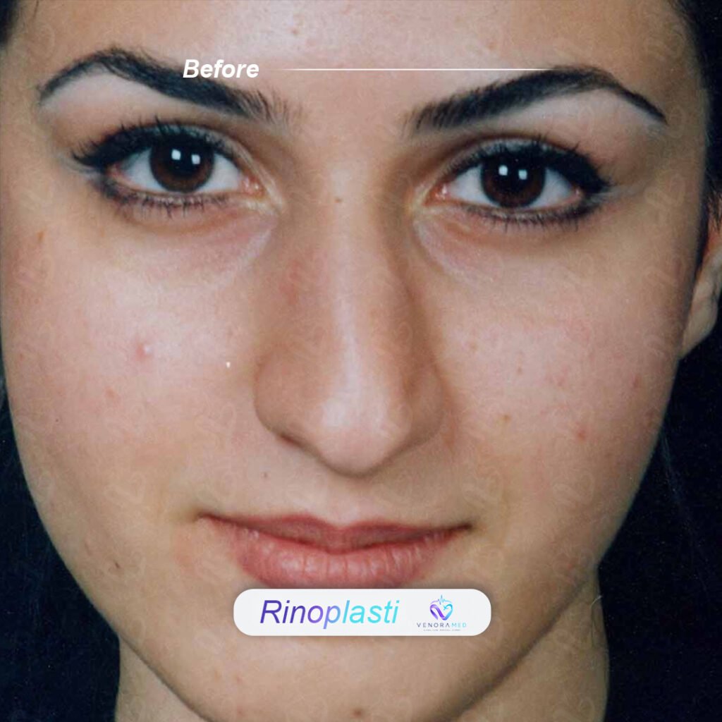 Rhinoplasty before