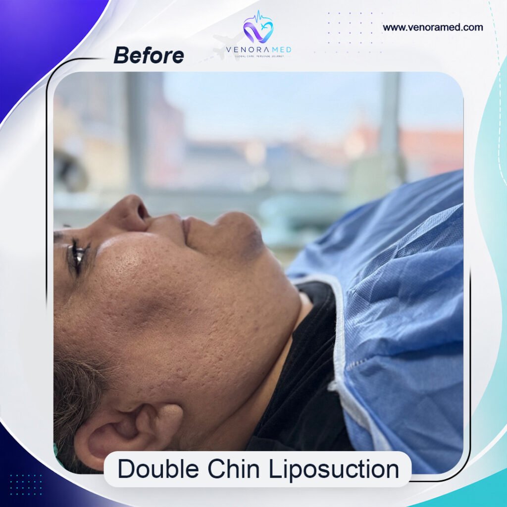 Double Chin Liposuction before
