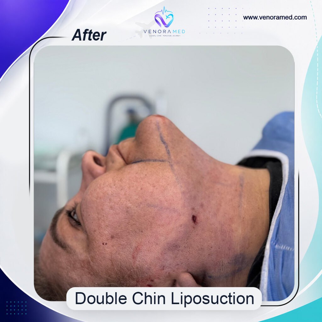 Double Chin Liposuction after