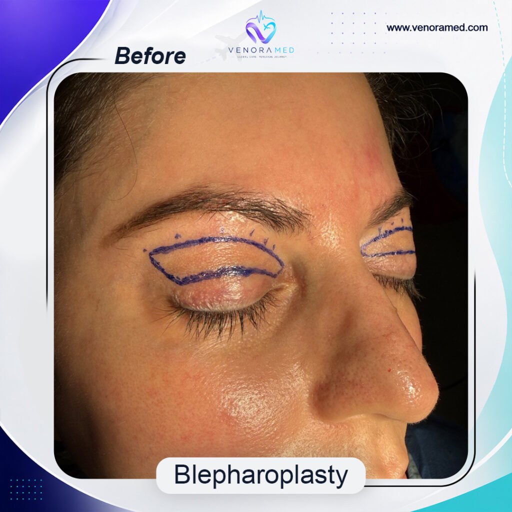 Blepharoplasty before