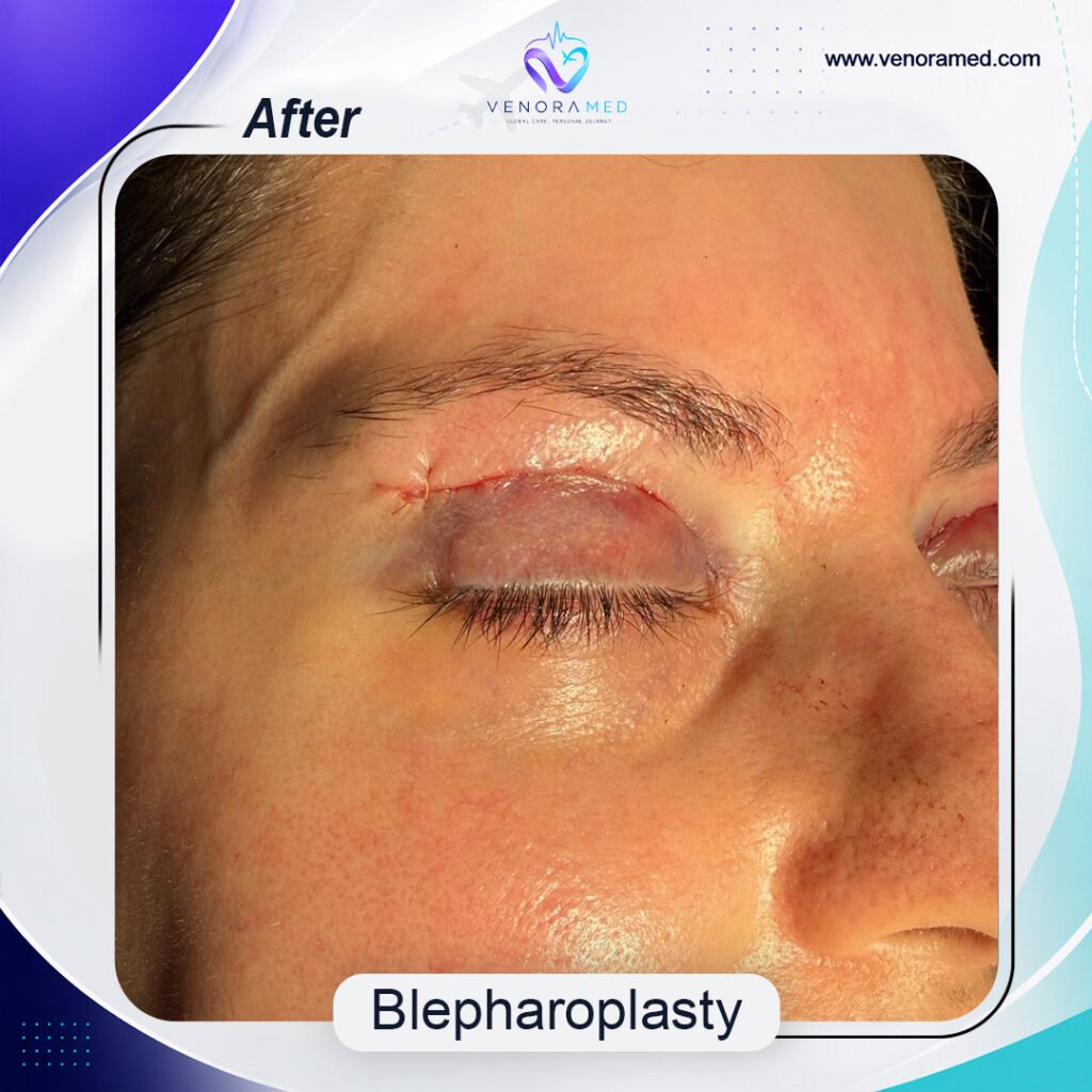 Blepharoplasty after