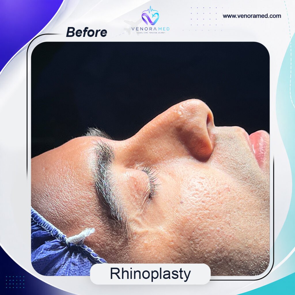 Rhinoplasty  before
