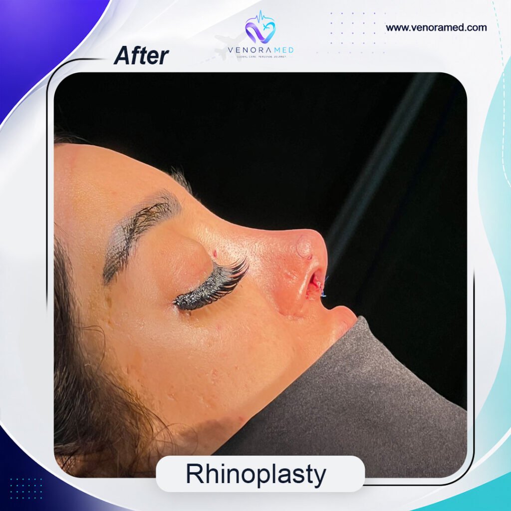 Rhinoplasty after