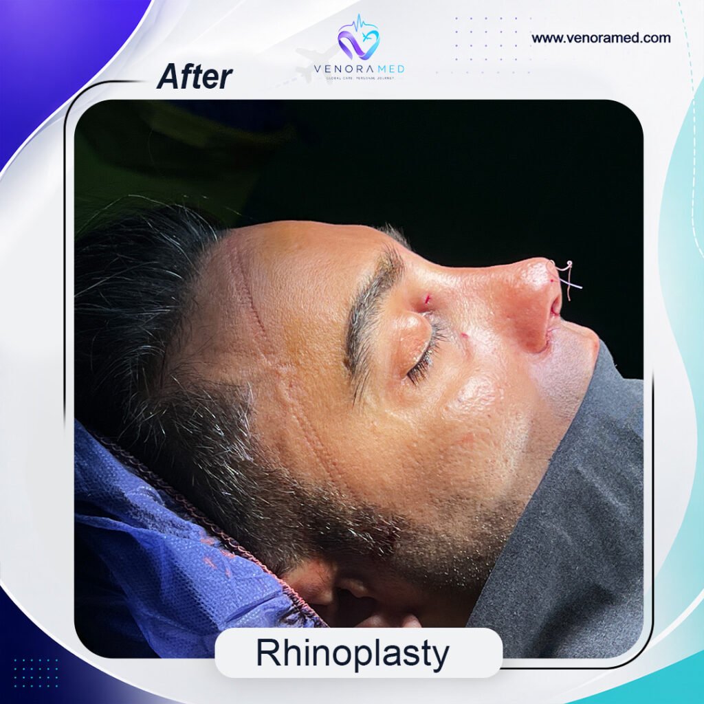 Rhinoplasty  after