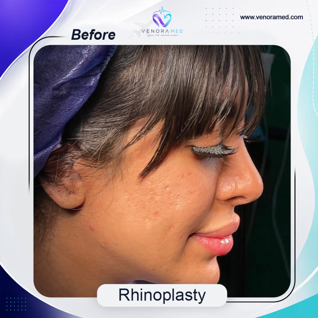 Rhinoplasty before