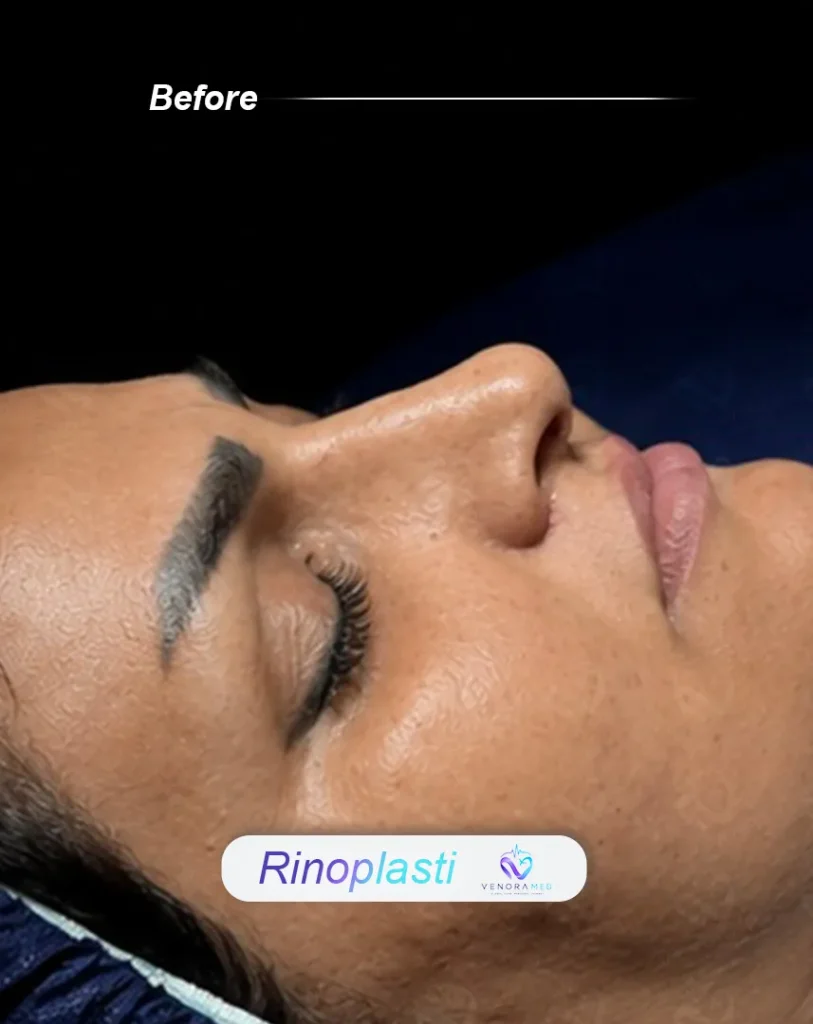 rhinoplasty before