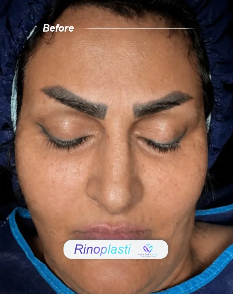 rhinoplasty before