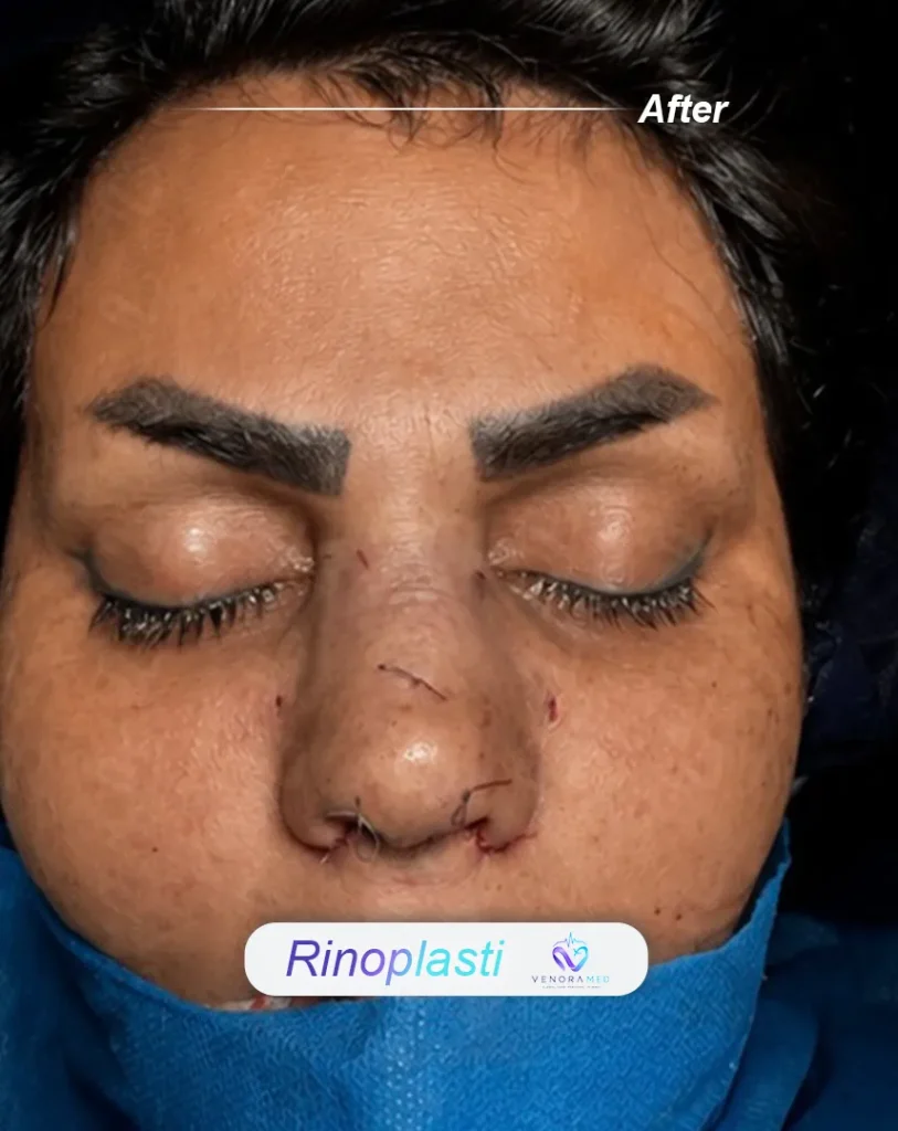rhinoplasty after