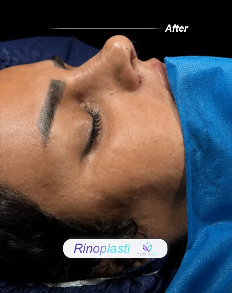 rhinoplasty after