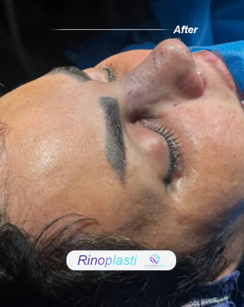 rhinoplasty after