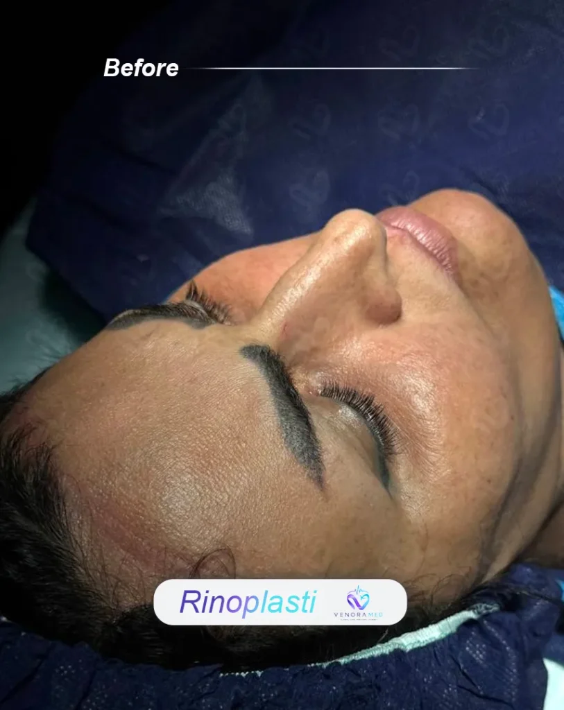 rhinoplasty before