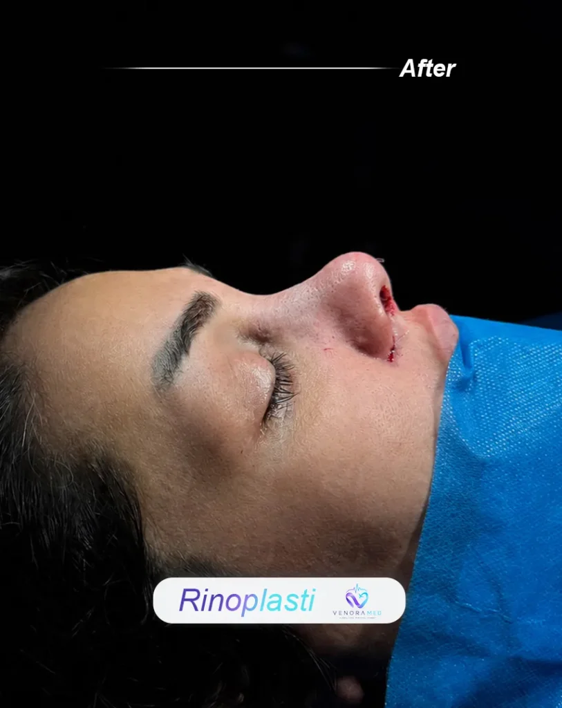 rhinoplasty after