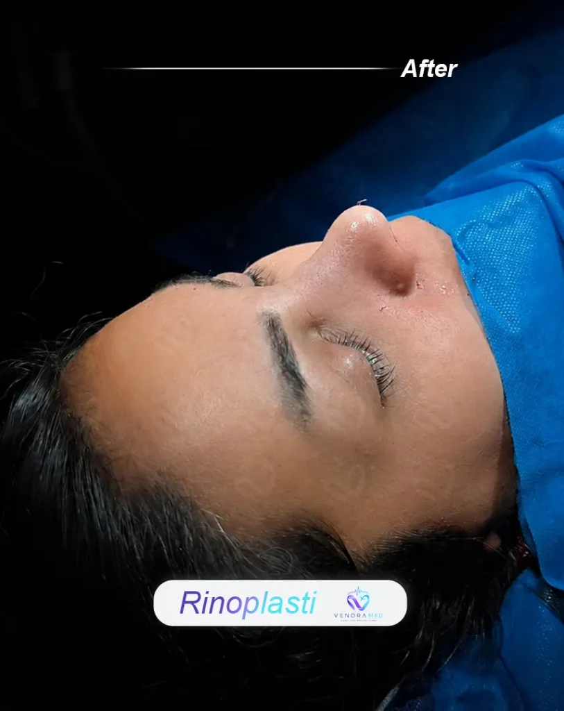 rhinoplasty after