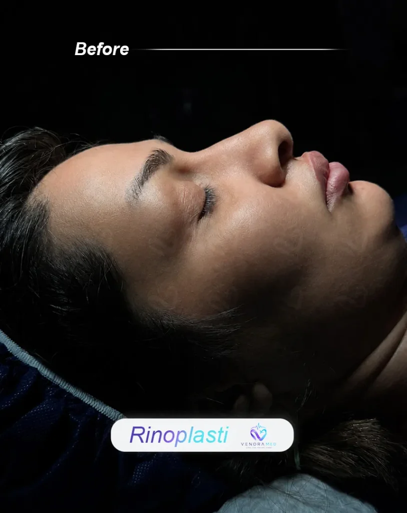 rhinoplasty before
