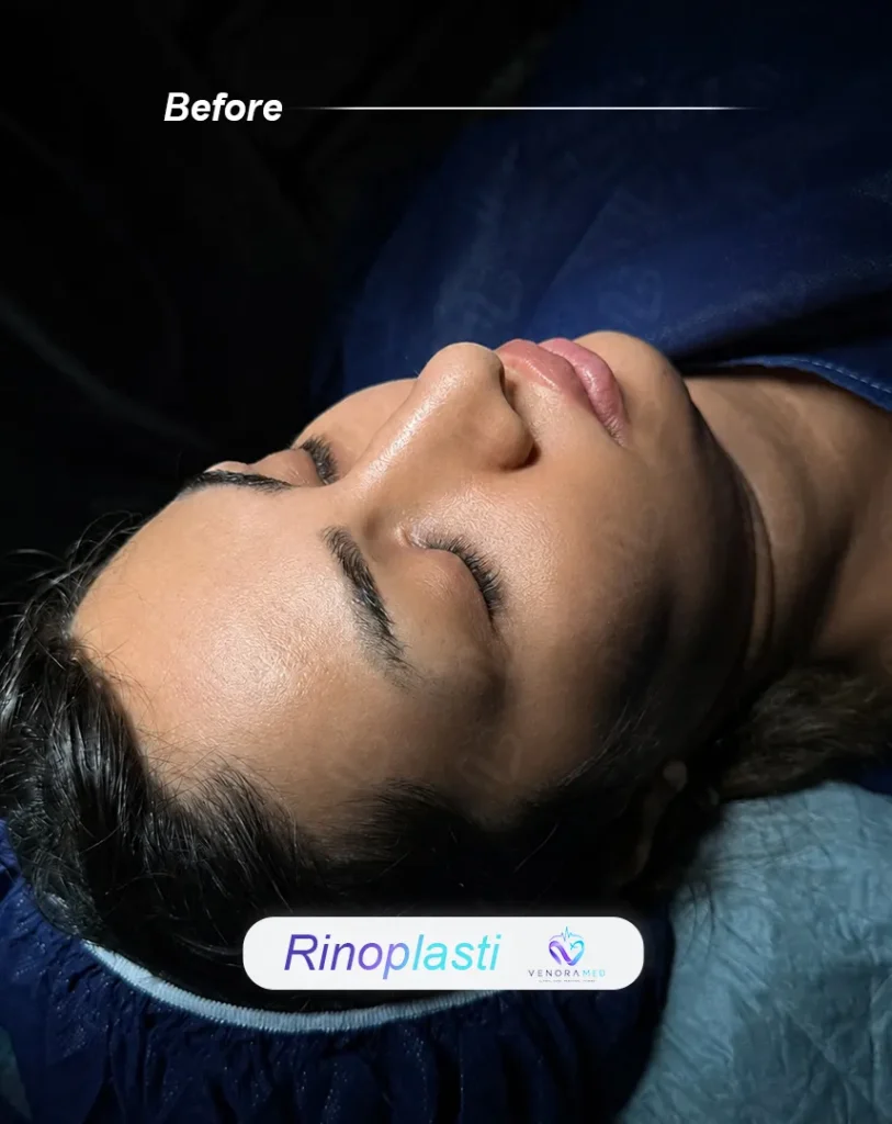 rhinoplasty before