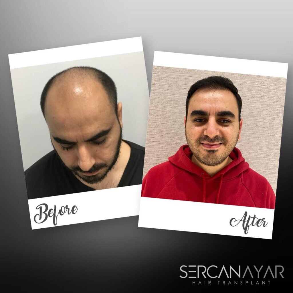 Hair Transplant after