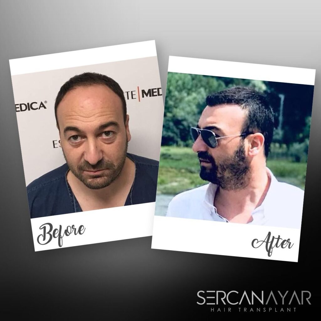 Hair Transplant after